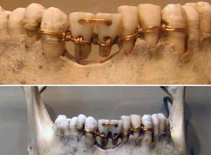 کاربرد طلا در دندانپزشکی و پزشکی